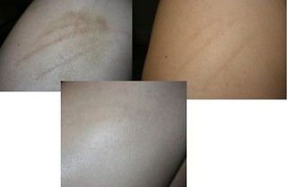   Scars Stretch Marks Uneven Tone Face Body Dry Skin Care BIO OIL