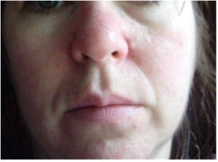 Epidermx 2 Microdermabrasion Cream Bye Wrinkles Acne