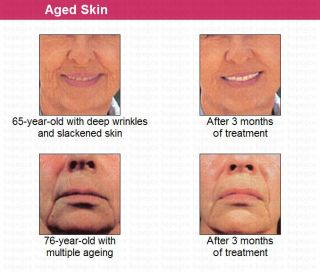 face becomes firmer and smoother as signs of aging diminish