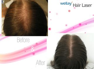 Hair Care Laser Therapy Hair Regrowth Cutting Edge Tech for Home